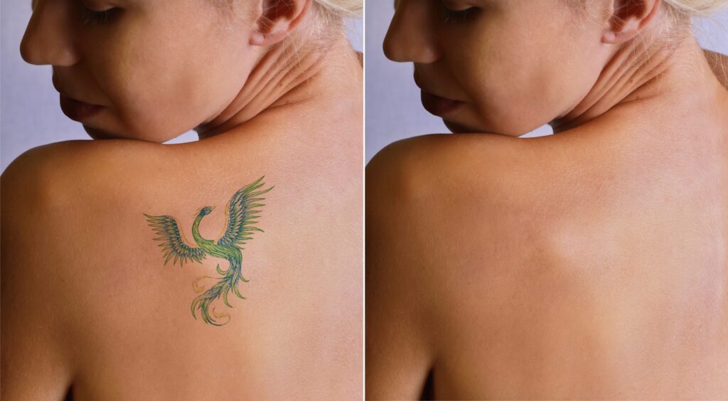 Tattoo Removal